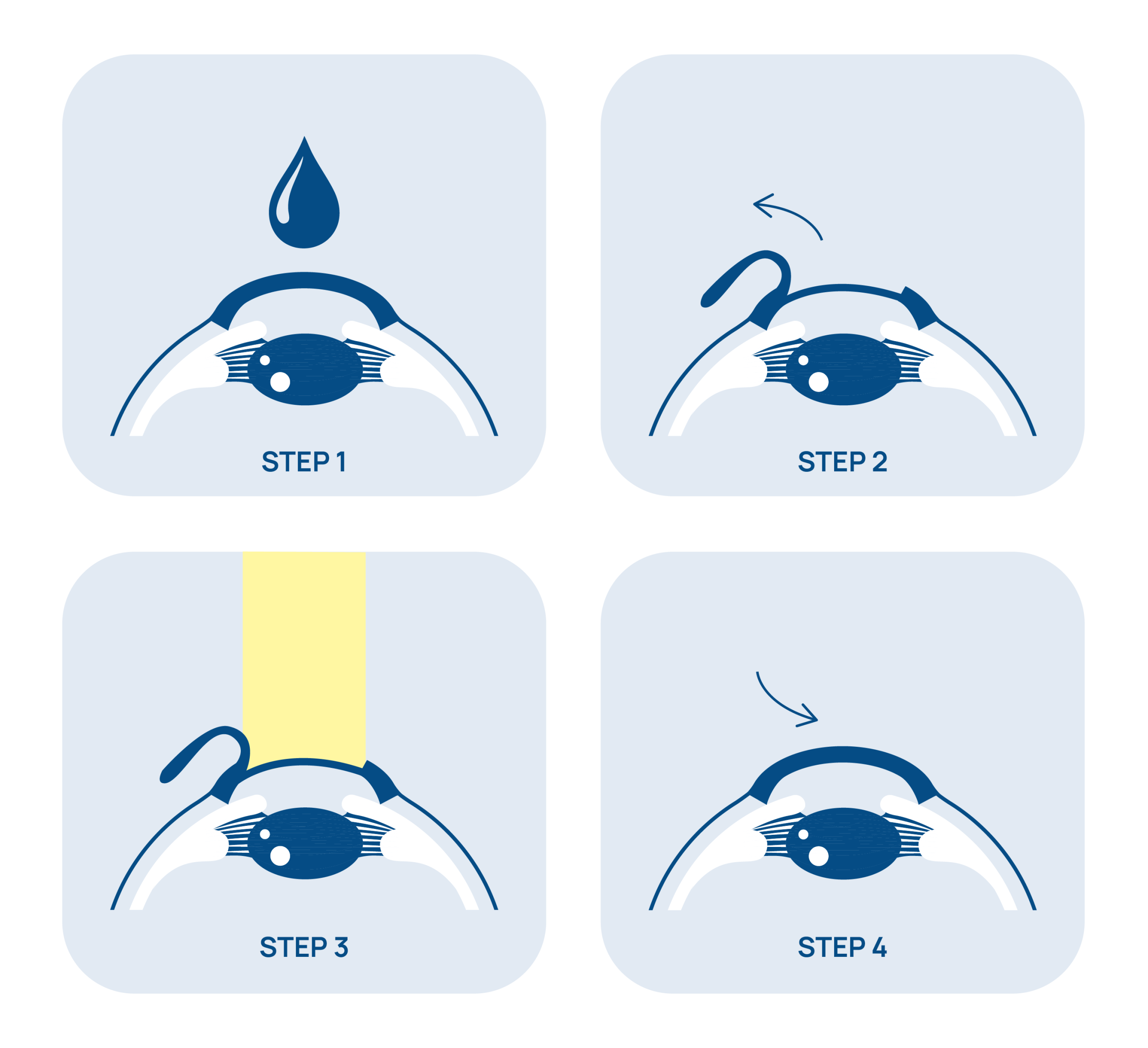 Schema dell’intervento Femto-LASIK — Chirurgia refrattiva Edoria Vision